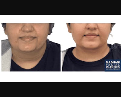 Buccal Fat Reduction Before & After Gallery - Patient 303556 - Image 1