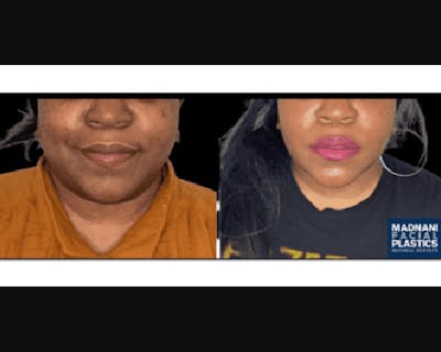 Buccal Fat Reduction Before & After Gallery - Patient 244776 - Image 1