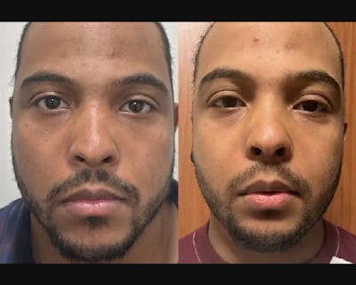 Buccal Fat Reduction Before & After Gallery - Patient 561518 - Image 1