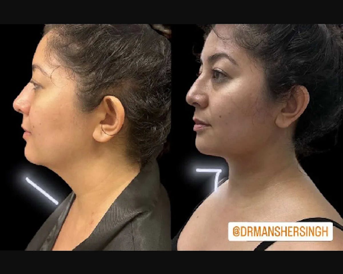 Chin & Neck Lipo Sculpting Before & After Gallery - Patient 219087 - Image 1