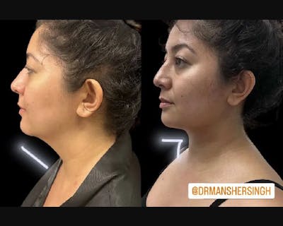 Chin & Neck Lipo Sculpting Before & After Gallery - Patient 219087 - Image 1