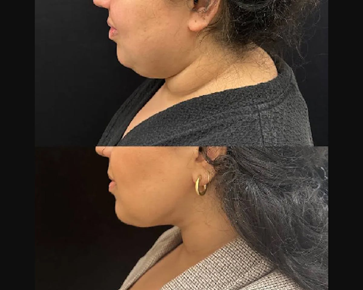 Chin & Neck Lipo Sculpting Before & After Gallery - Patient 311323 - Image 1