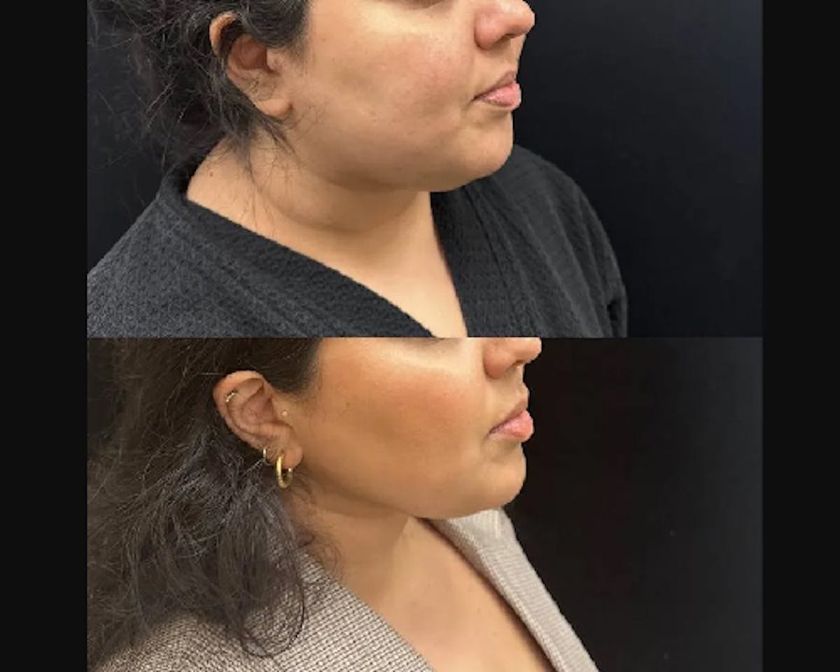 Chin & Neck Lipo Sculpting Before & After Gallery - Patient 311323 - Image 2