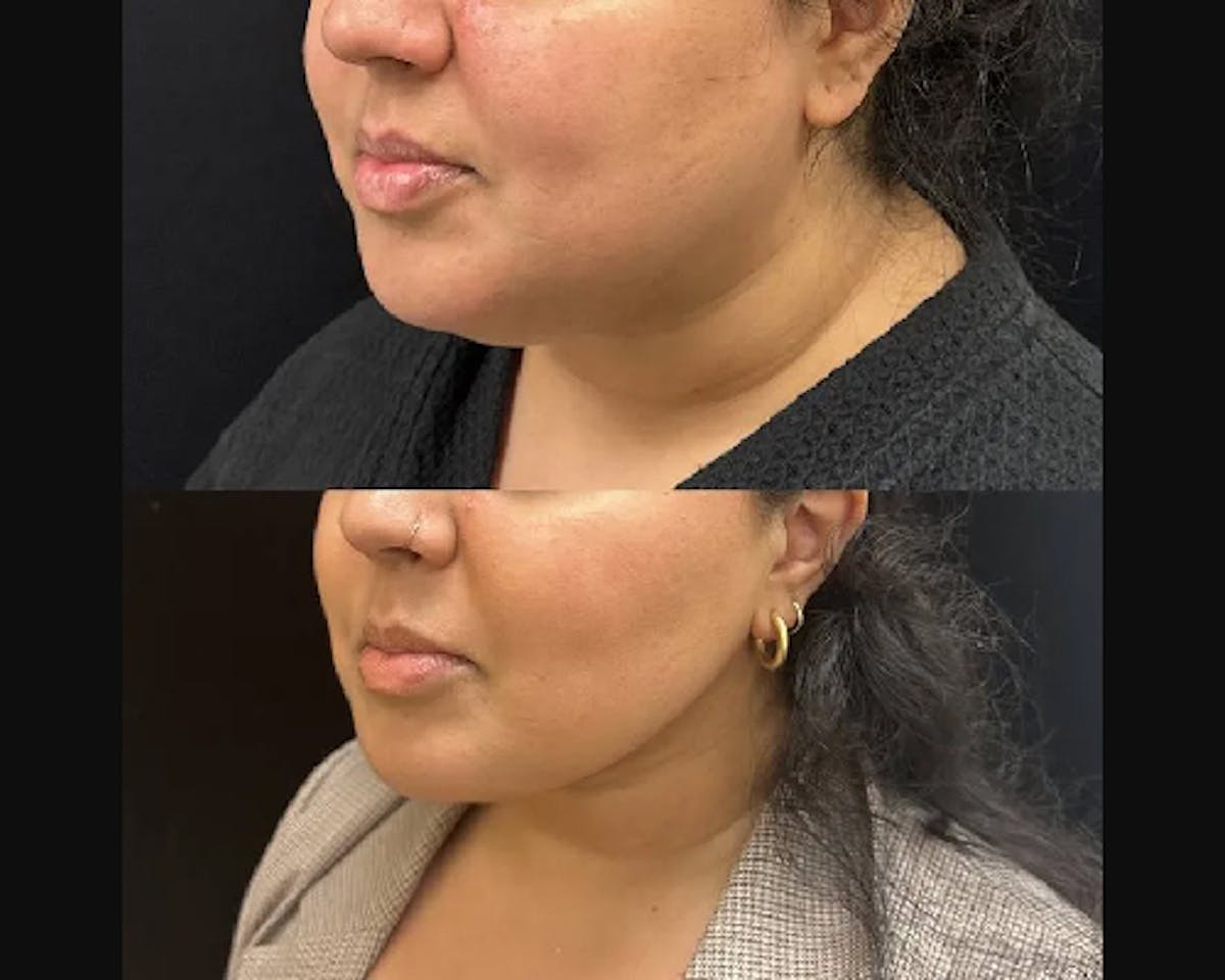 Chin & Neck Lipo Sculpting Before & After Gallery - Patient 311323 - Image 3