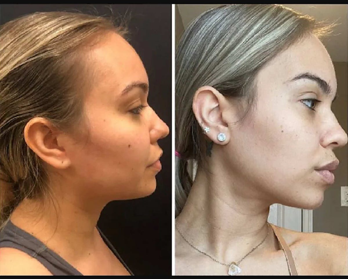 Chin & Neck Lipo Sculpting Before & After Gallery - Patient 395787 - Image 1