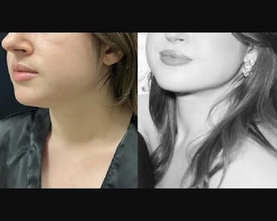 Chin & Neck Lipo Sculpting Before & After Gallery - Patient 306080 - Image 1