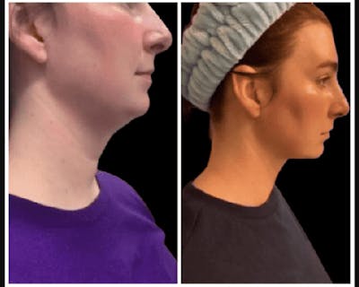 Chin & Neck Lipo Sculpting Before & After Gallery - Patient 291136 - Image 1