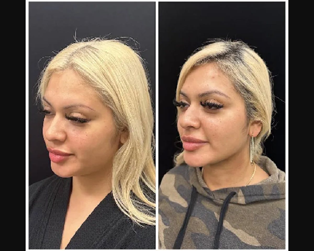 Chin & Neck Lipo Sculpting Before & After Gallery - Patient 288829 - Image 1