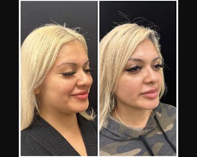 Chin & Neck Lipo Sculpting Before & After Gallery - Patient 288829 - Image 2