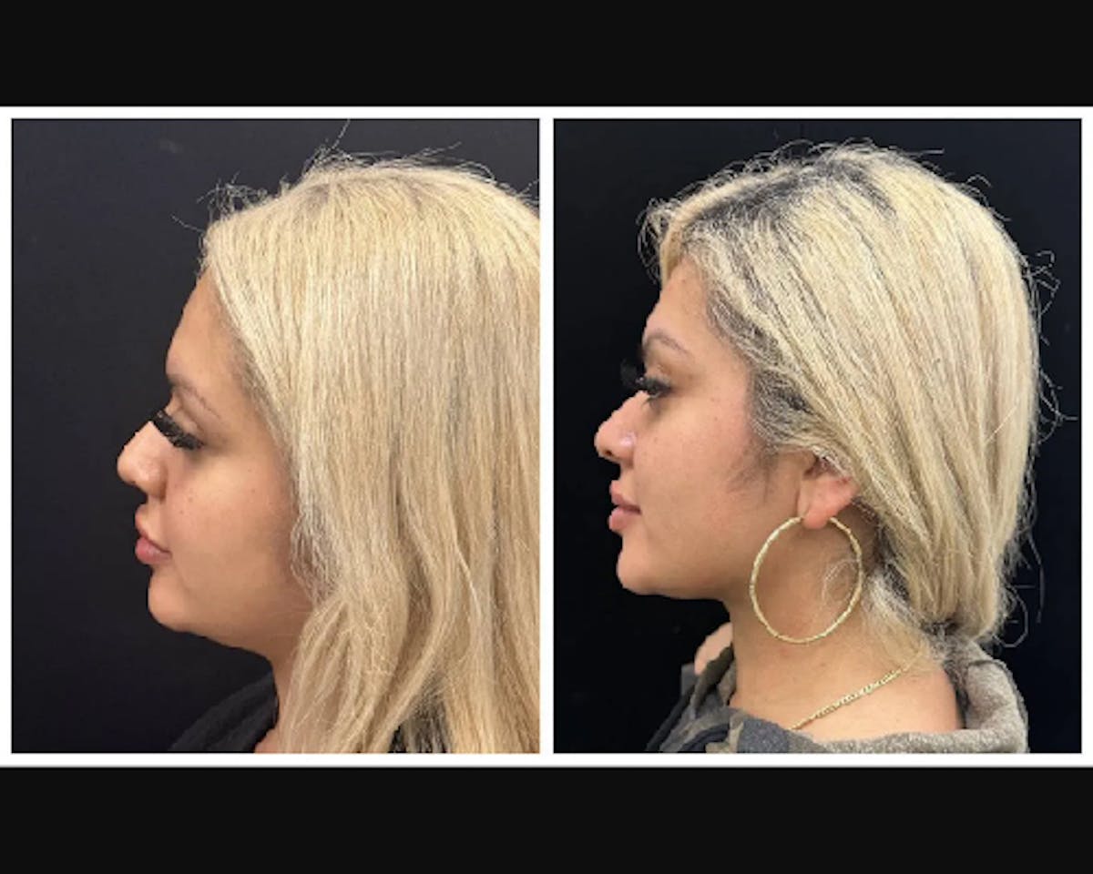 Chin & Neck Lipo Sculpting Before & After Gallery - Patient 288829 - Image 3