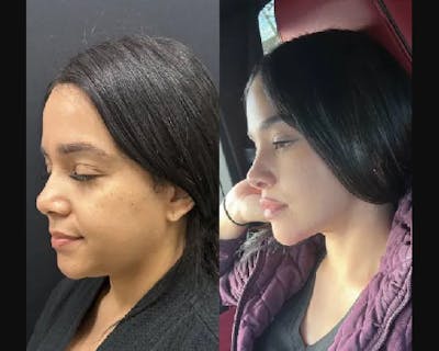 Chin & Neck Lipo Sculpting Before & After Gallery - Patient 177664 - Image 1