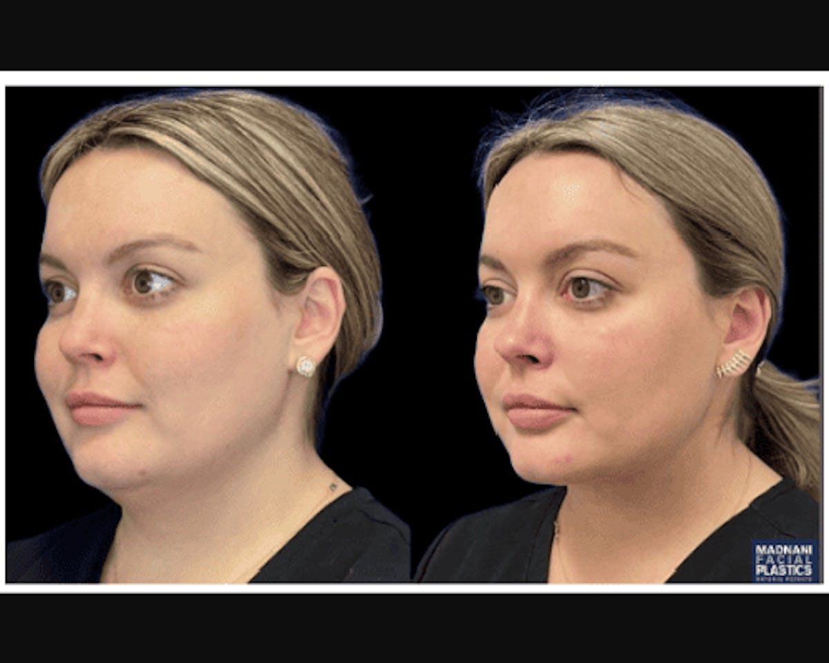 Chin & Neck Lipo Sculpting Before & After Gallery - Patient 353678 - Image 2