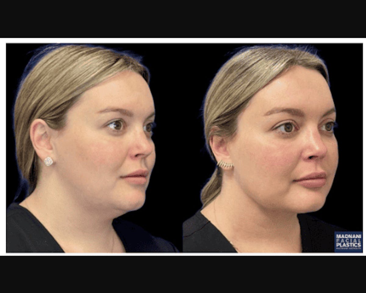 Chin & Neck Lipo Sculpting Before & After Gallery - Patient 353678 - Image 3