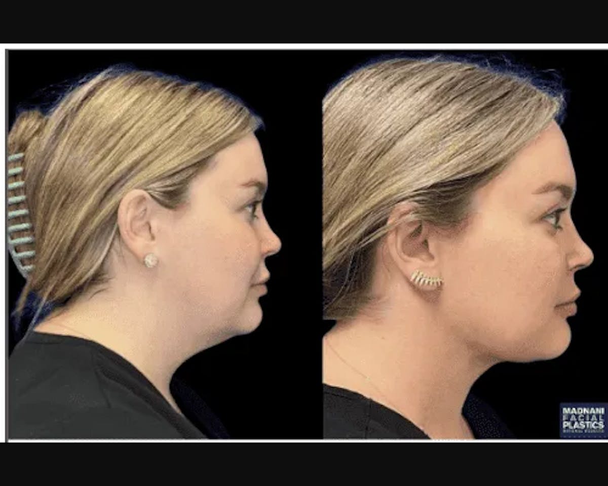 Chin & Neck Lipo Sculpting Before & After Gallery - Patient 353678 - Image 4