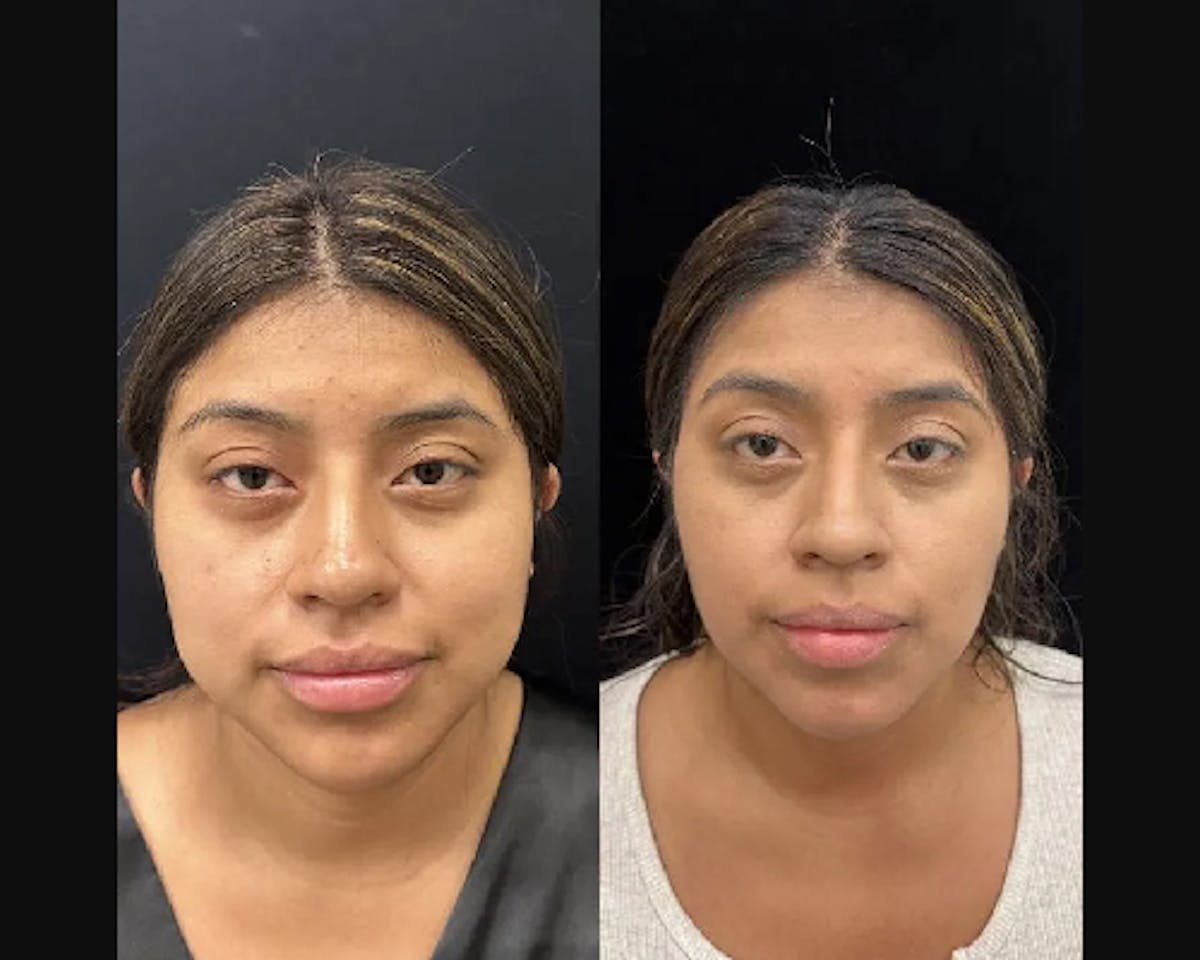 Chin & Neck Lipo Sculpting Before & After Gallery - Patient 223975 - Image 1