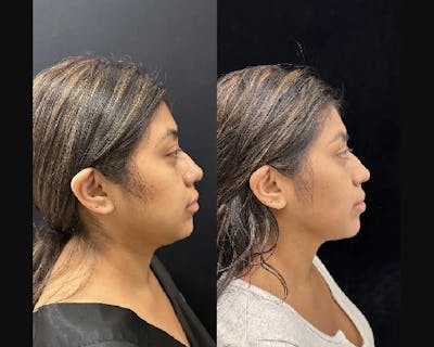 Chin & Neck Lipo Sculpting Before & After Gallery - Patient 223975 - Image 2