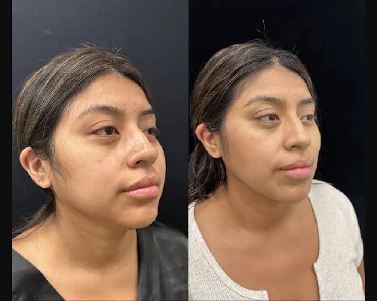 Chin & Neck Lipo Sculpting Before & After Gallery - Patient 223975 - Image 3