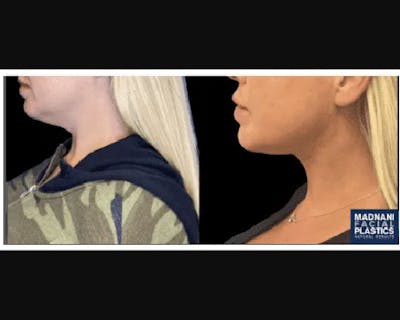 Chin & Neck Lipo Sculpting Before & After Gallery - Patient 426294 - Image 1