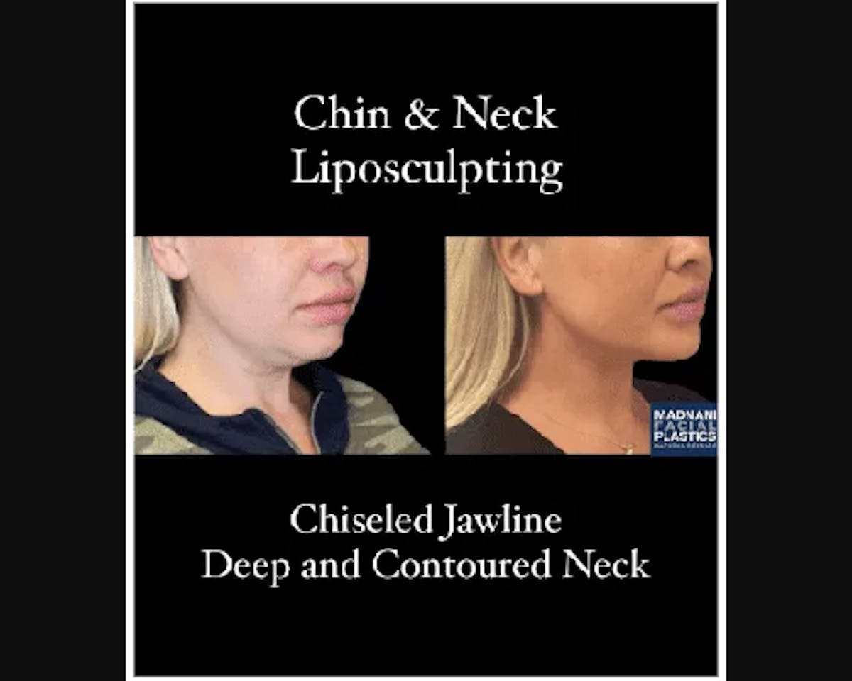 Chin & Neck Lipo Sculpting Before & After Gallery - Patient 426294 - Image 2