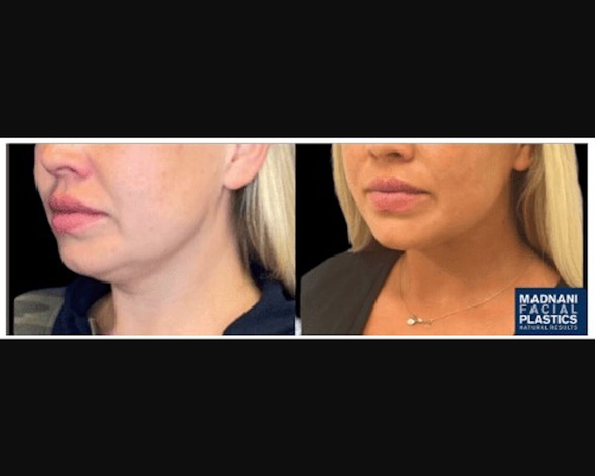 Chin & Neck Lipo Sculpting Before & After Gallery - Patient 426294 - Image 3