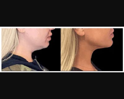 Chin & Neck Lipo Sculpting Before & After Gallery - Patient 426294 - Image 4