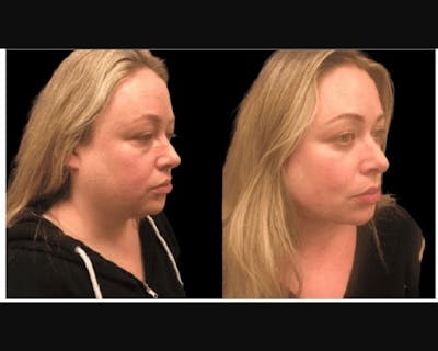 Chin & Neck Lipo Sculpting Before & After Gallery - Patient 166158 - Image 1