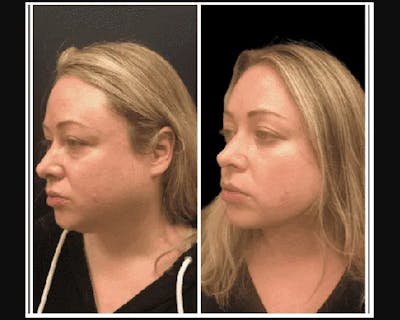 Chin & Neck Lipo Sculpting Before & After Gallery - Patient 166158 - Image 2