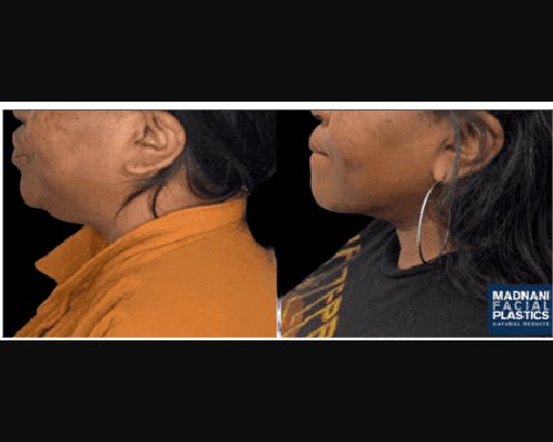 Chin & Neck Lipo Sculpting Before & After Gallery - Patient 727911 - Image 1
