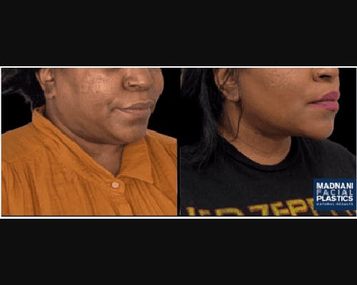 Chin & Neck Lipo Sculpting Before & After Gallery - Patient 727911 - Image 3