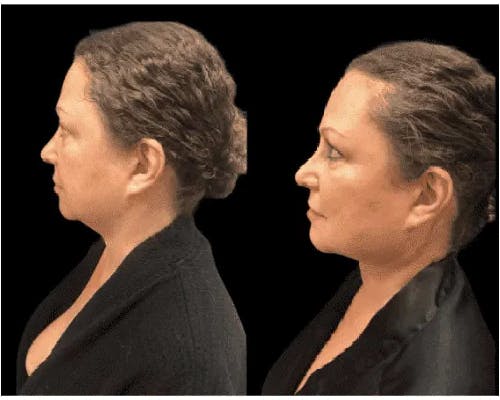 Chin & Neck Lipo Sculpting Before & After Gallery - Patient 253492 - Image 1