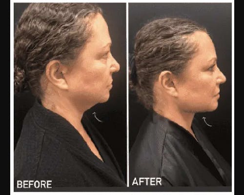 Chin & Neck Lipo Sculpting Before & After Gallery - Patient 253492 - Image 2