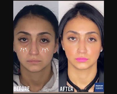 Facial Fat Transfer Before & After Gallery - Patient 192177 - Image 1