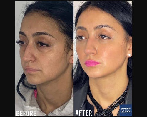 Facial Fat Transfer Before & After Gallery - Patient 192177 - Image 2