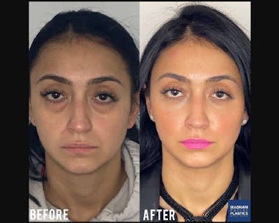Facial Fat Transfer Before & After Gallery - Patient 192177 - Image 3