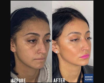 Facial Fat Transfer Before & After Gallery - Patient 192177 - Image 4