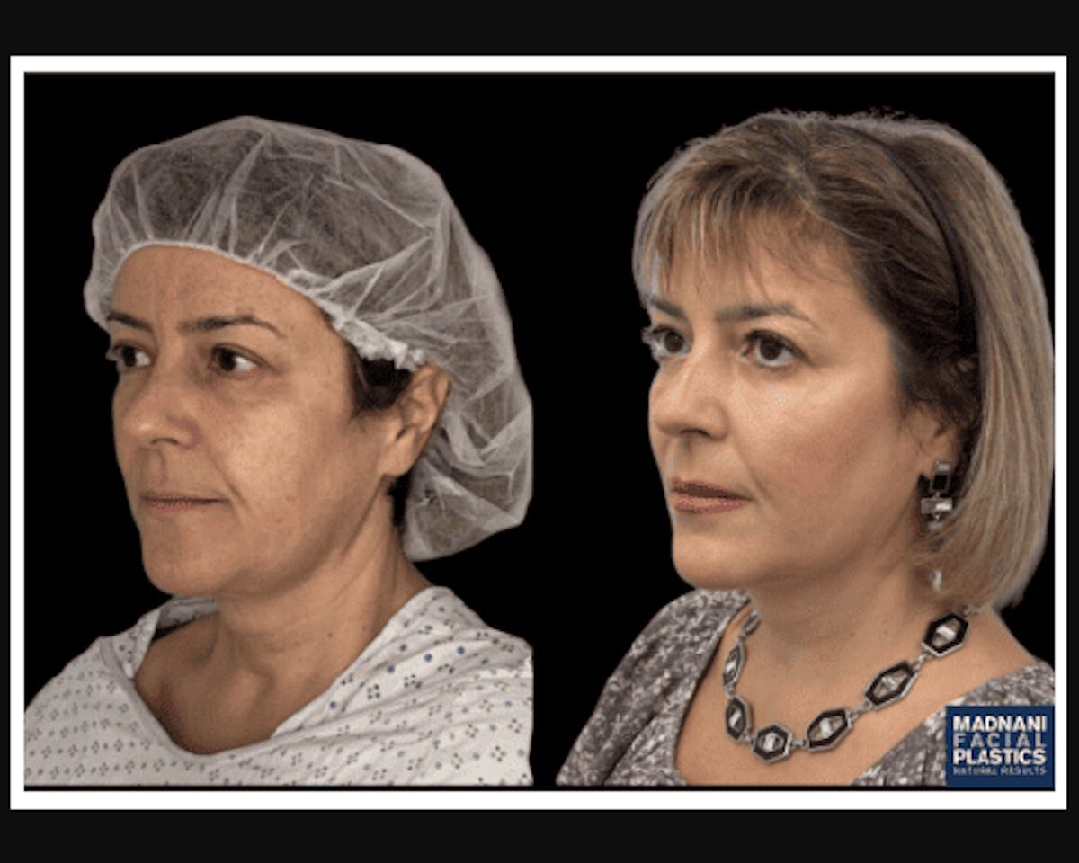  Facial Fat Transfer Before & After Gallery - Patient 117974 - Image 2
