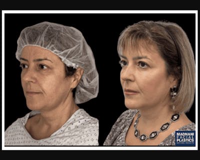 Facial Fat Transfer Before & After Gallery - Patient 117974 - Image 2