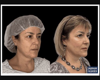 Facial Fat Transfer Before & After Gallery - Patient 117974 - Image 3