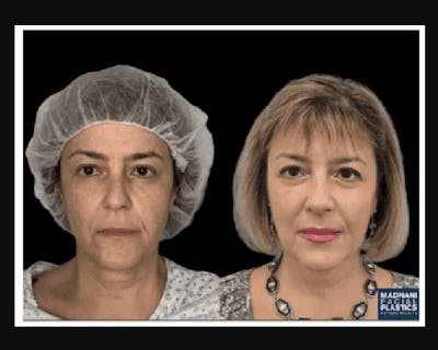Facial Fat Transfer Before & After Gallery - Patient 117974 - Image 4