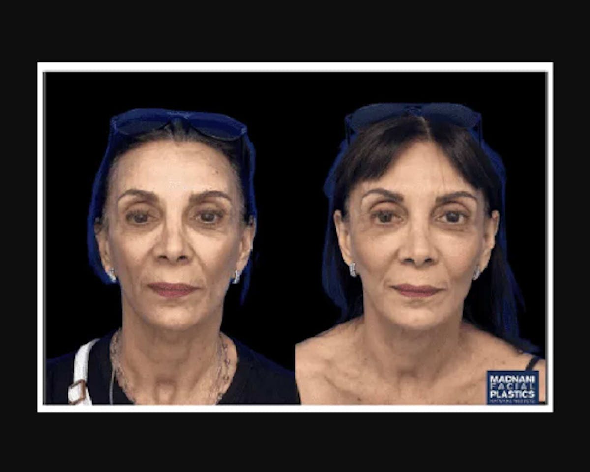  Facial Fat Transfer Before & After Gallery - Patient 322090 - Image 1