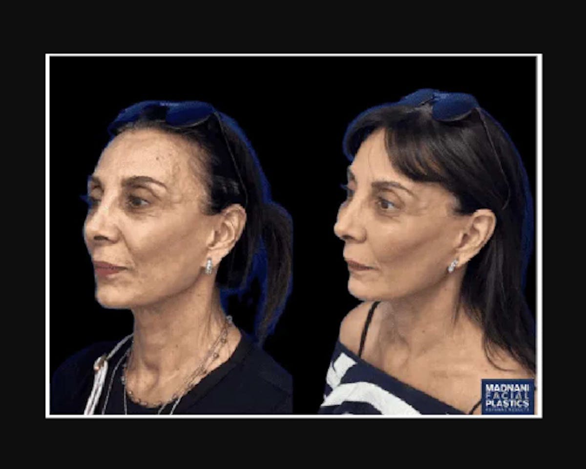  Facial Fat Transfer Before & After Gallery - Patient 322090 - Image 2