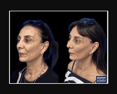 Facial Fat Transfer Before & After Gallery - Patient 322090 - Image 2