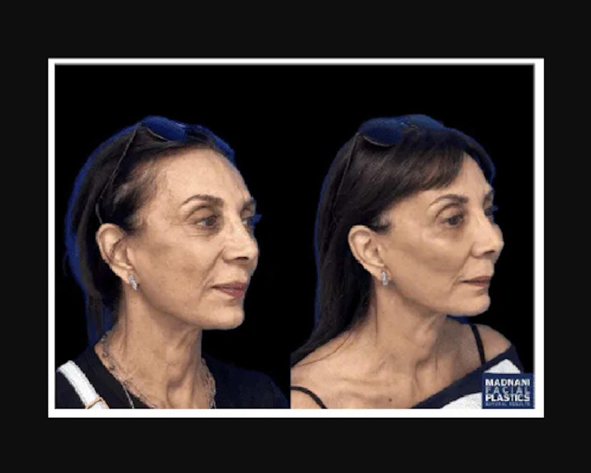  Facial Fat Transfer Before & After Gallery - Patient 322090 - Image 3