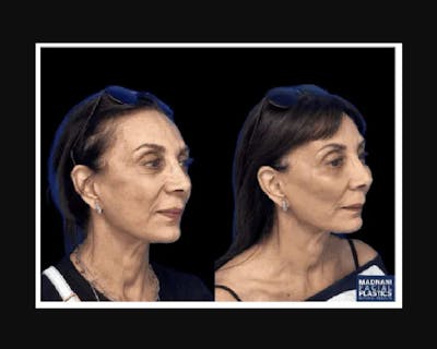 Facial Fat Transfer Before & After Gallery - Patient 322090 - Image 3