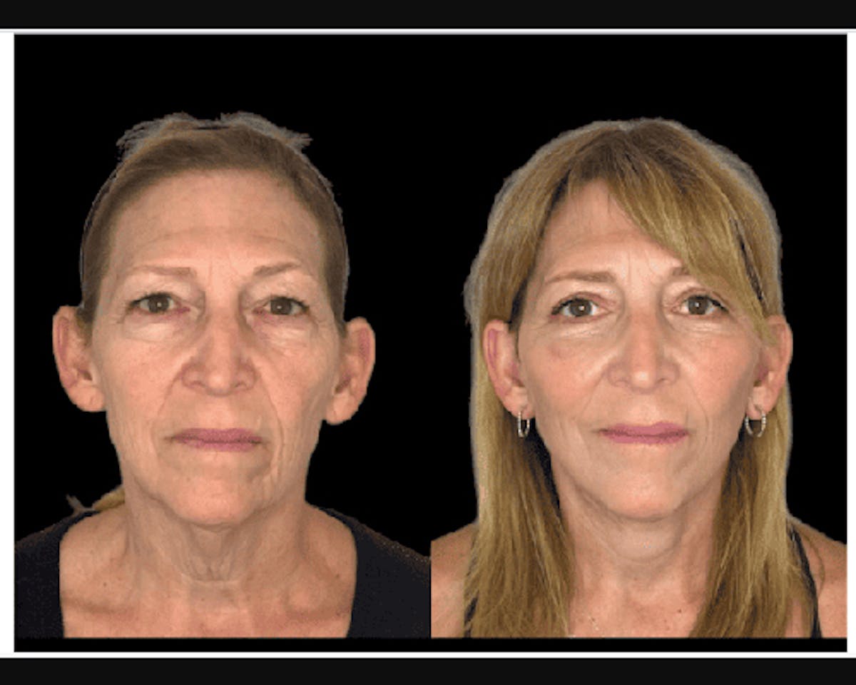  Facial Fat Transfer Before & After Gallery - Patient 284158 - Image 1
