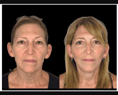 Facial Fat Transfer Before & After Gallery - Patient 284158 - Image 1