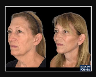 Facial Fat Transfer Before & After Gallery - Patient 284158 - Image 2