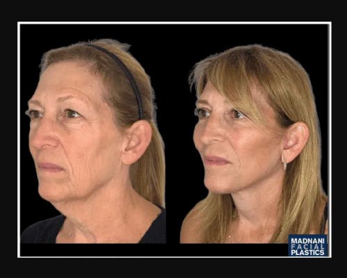 Facial Fat Transfer Before & After Gallery - Patient 284158 - Image 2