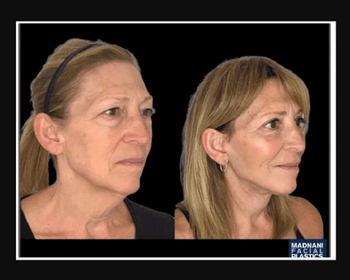  Facial Fat Transfer Before & After Gallery - Patient 284158 - Image 3