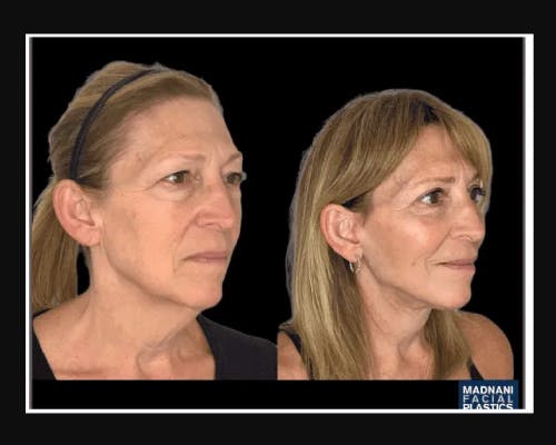 Facial Fat Transfer Before & After Gallery - Patient 284158 - Image 3